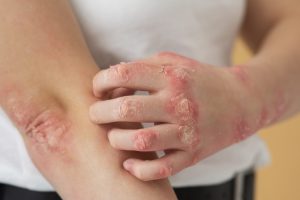 Psoriasis 69