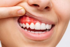 Gum inflammation. Cropped shot of a young woman showing bleeding gums isolated on a white background. Dentistry, dental care